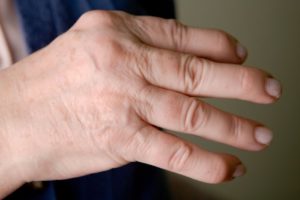 Rheumatoid Psoriatic Osteoarthritis