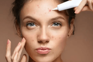 cao bí đao và cao tinh nghệ nên chọn loại nào để trị mụn