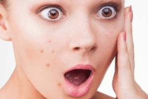 decumar trị mụn dùng sao cho hiệu quả