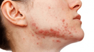 mụn do nội tiết tố