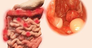 viêm loét đại tràng