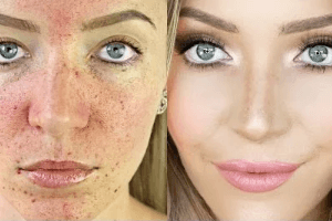 bột nghệ điều trị sẹo và sạm da