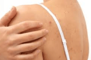 cách điều trị mụn lưng và cách phòng ngừa