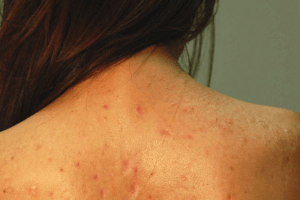 cách trị mụn lưng tại nhà