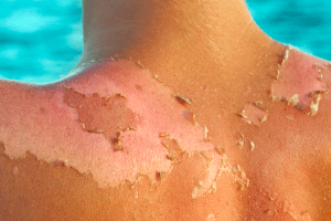 da bị cháy nắng và cách phục hồi