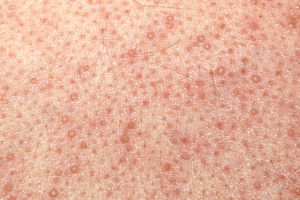 điều trị viêm lỗ chân lông