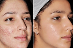 mặt nạ trị thâm mụn tại nhà