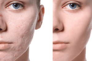 những thực phẩm gây mọc mụn trứng cá