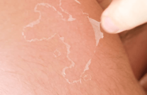 triệu chứng khi bị cháy nắng