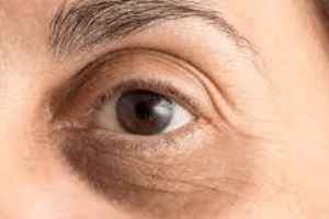 cách trị thâm quầng mắt tự nhiên