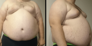 hội chứng chuyển hóa