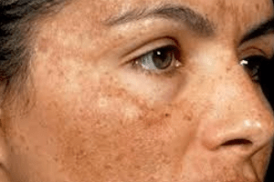 đắp mặt nạ trị nám