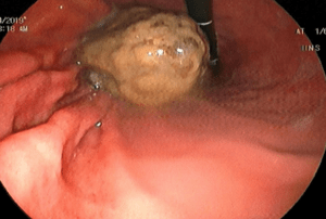 bã nghệ bị tắc trong dạ dày