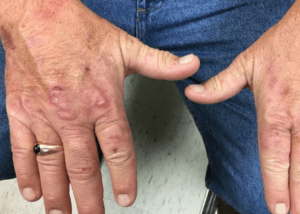 bệnh máu khó đông