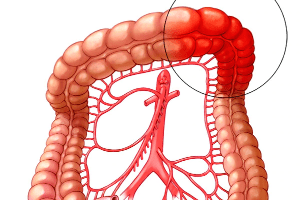 tinh nghệ đen có chữa được bệnh viêm đại tràng