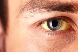 chữa vàng da do viêm gan bằng tinh bột nghệ đen