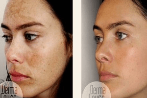 tinh bột nghệ đen tri nám