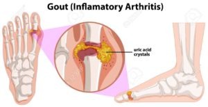 bệnh gout