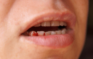 chảy nướu răng