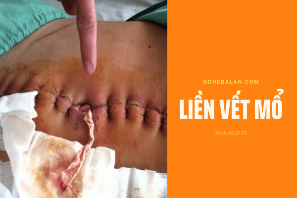 liền vết mổ