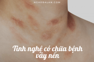 uống tinh nghệ có trị bệnh vảy nến