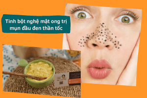 mặt nạ tinh bột nghệ mật ong trị mụn đầu đen