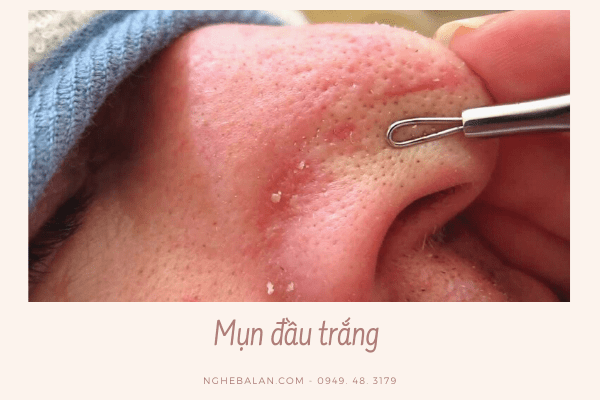 mụn đầu trắng